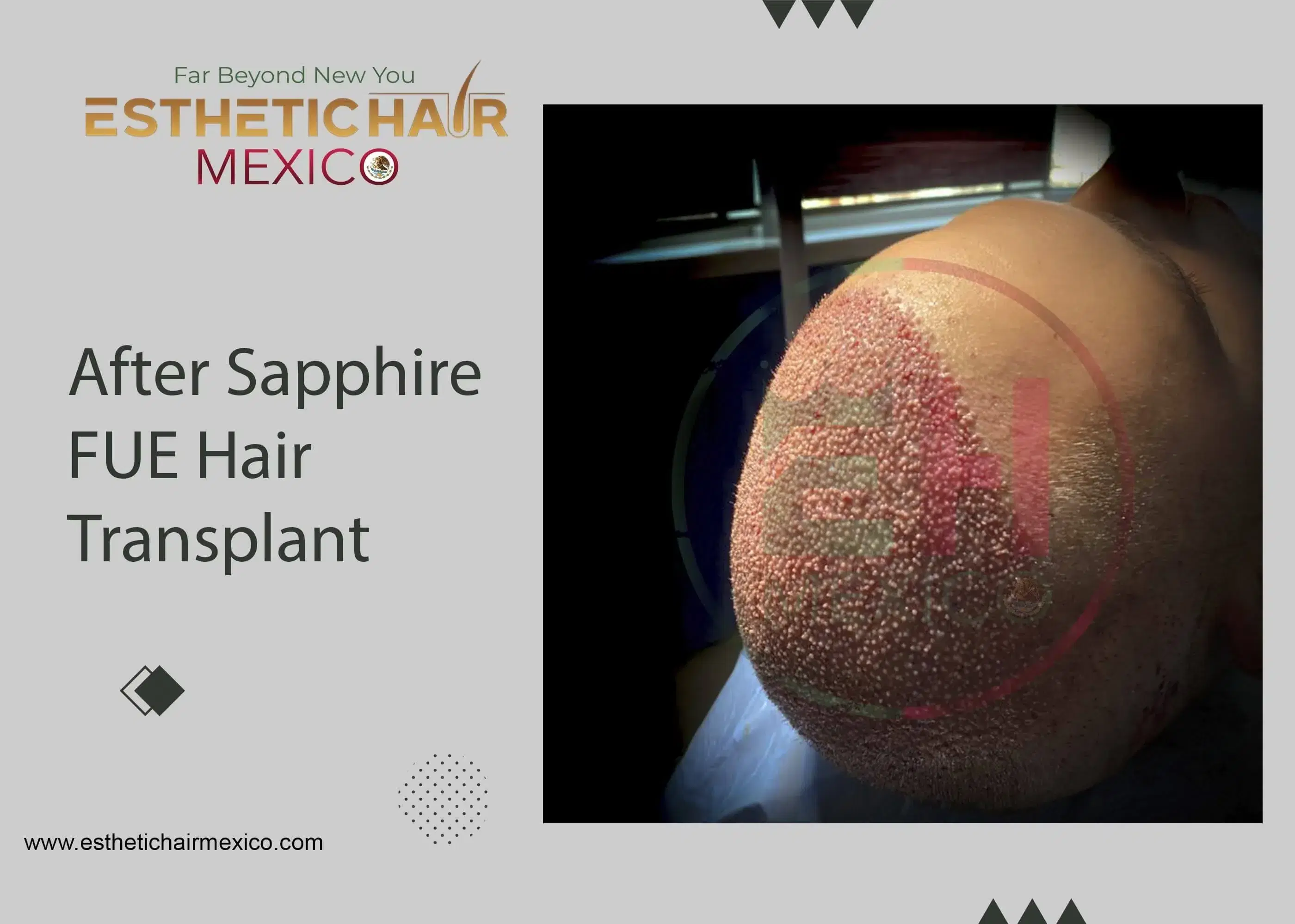 Trasplante Capilar DHI