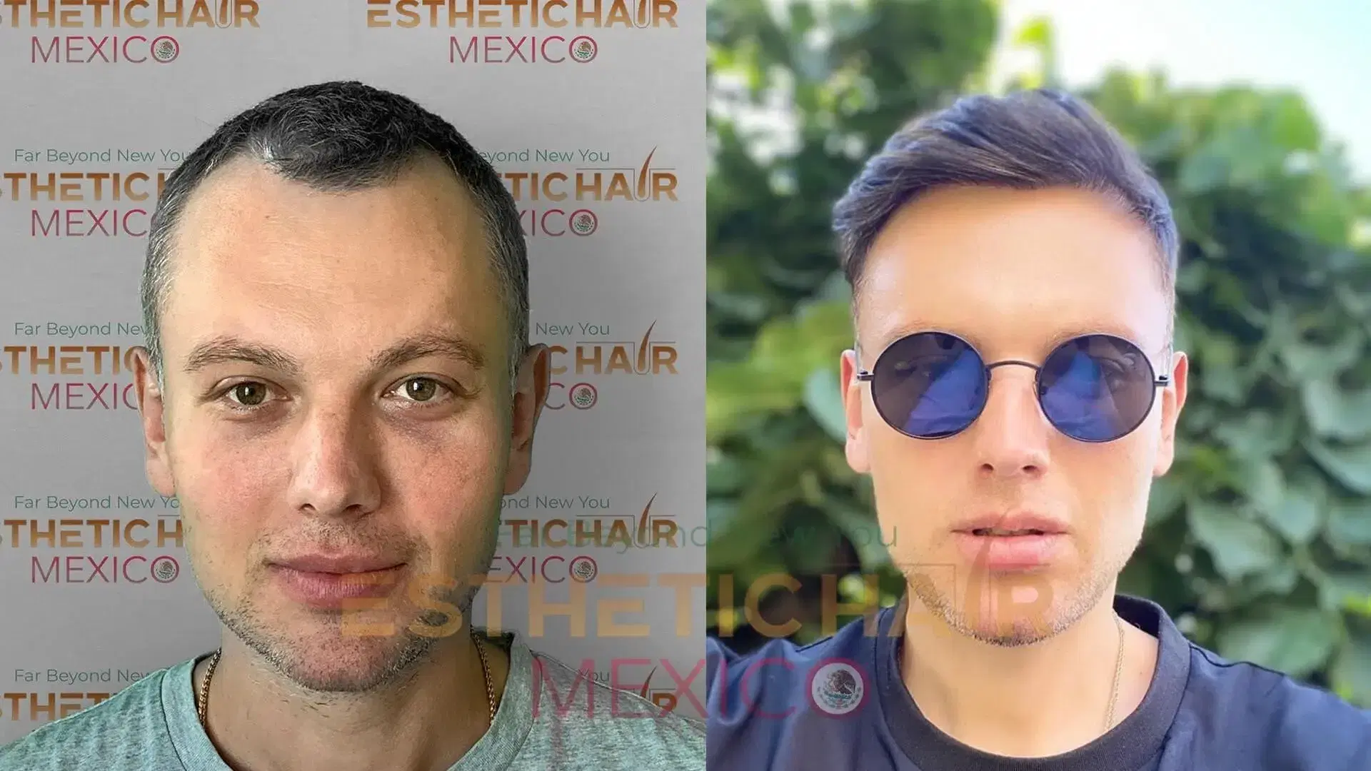 how-long-do-hair-transplants-last