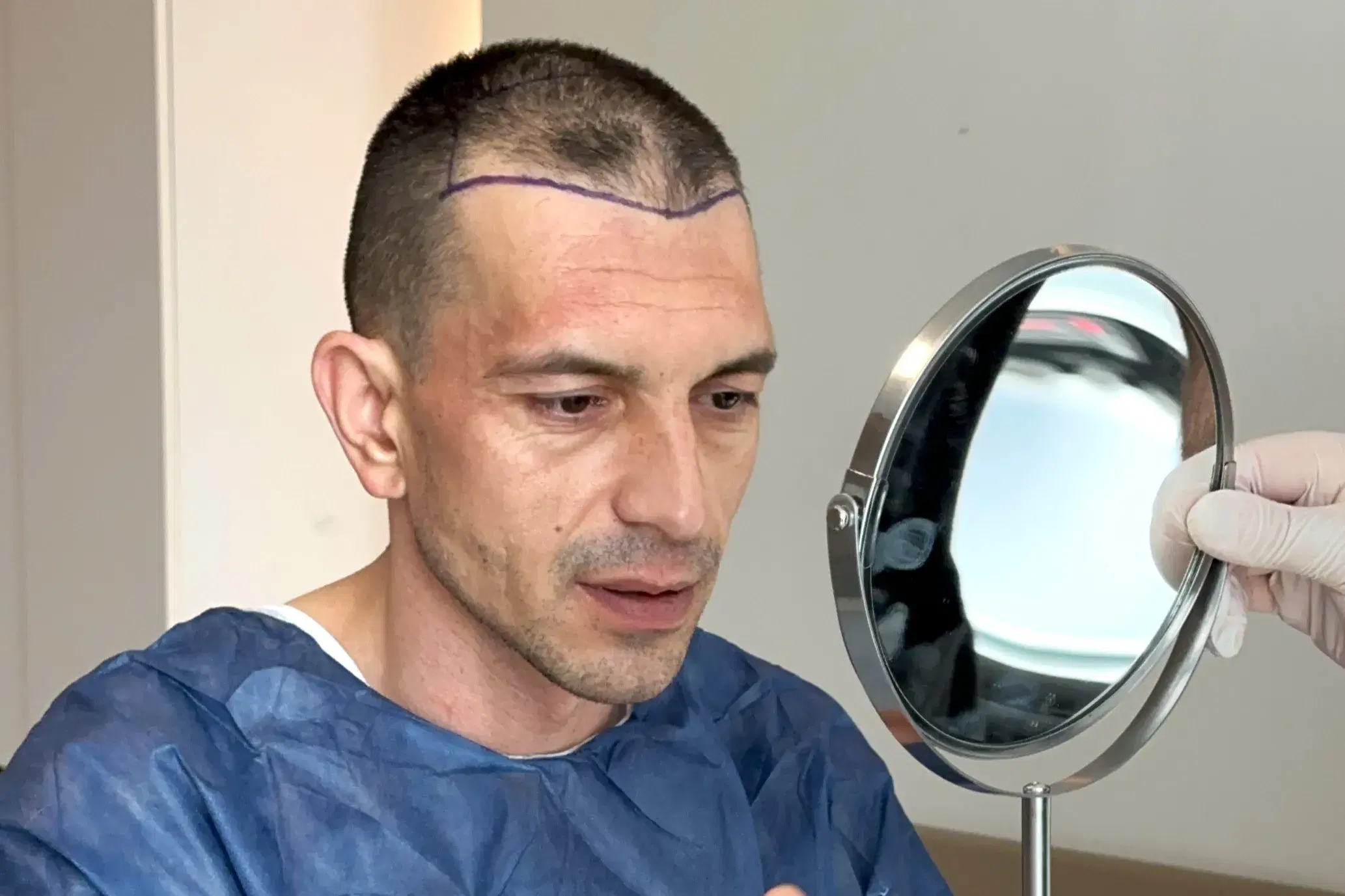 Trasplante de Cabello para Tipos de Cabello Latino: Planificación, Técnicas y Resultados