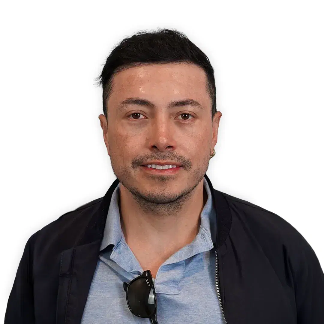 hair transplant result 10 months 3800 grafts canada