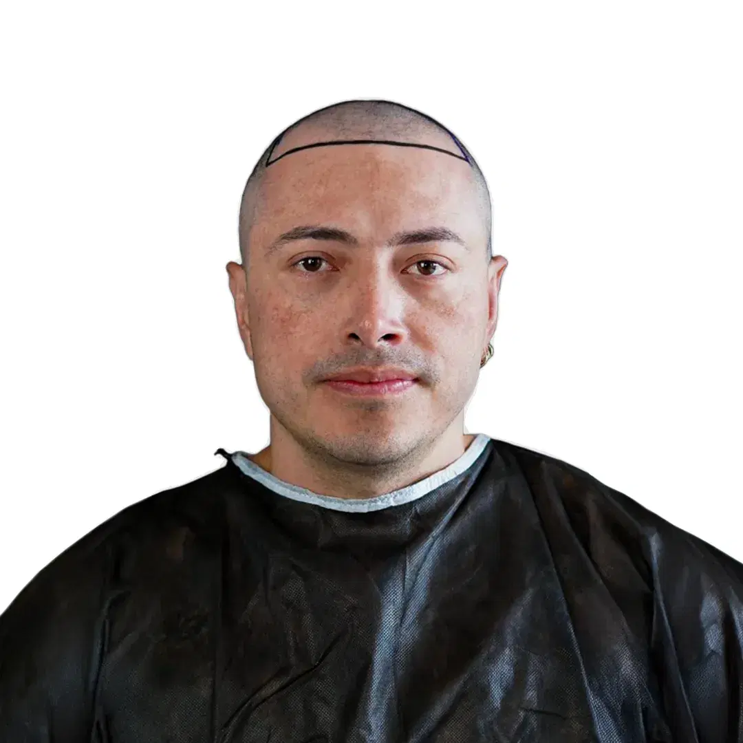 hair transplant before 3800 grafts canada