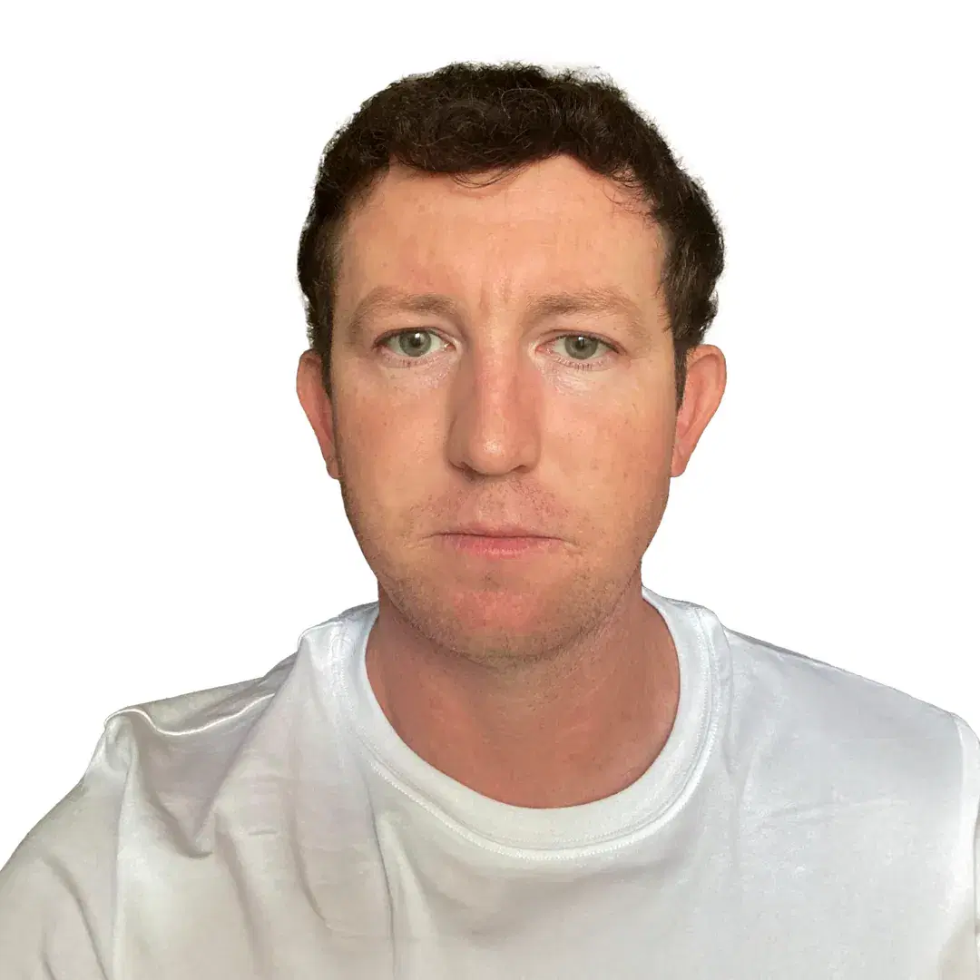 hair transplant result 7 months 2200 grafts canada