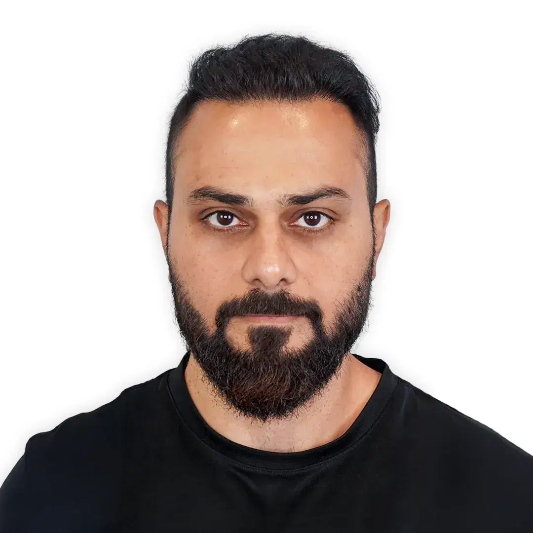 Hair transplant result after 10 months with 4000 grafts in Iran