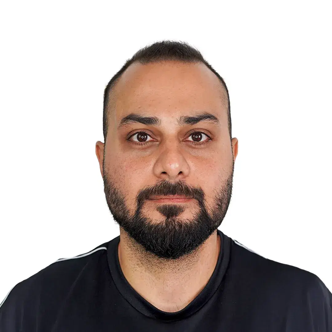 Hair transplant before procedure with 4000 grafts in Iran
