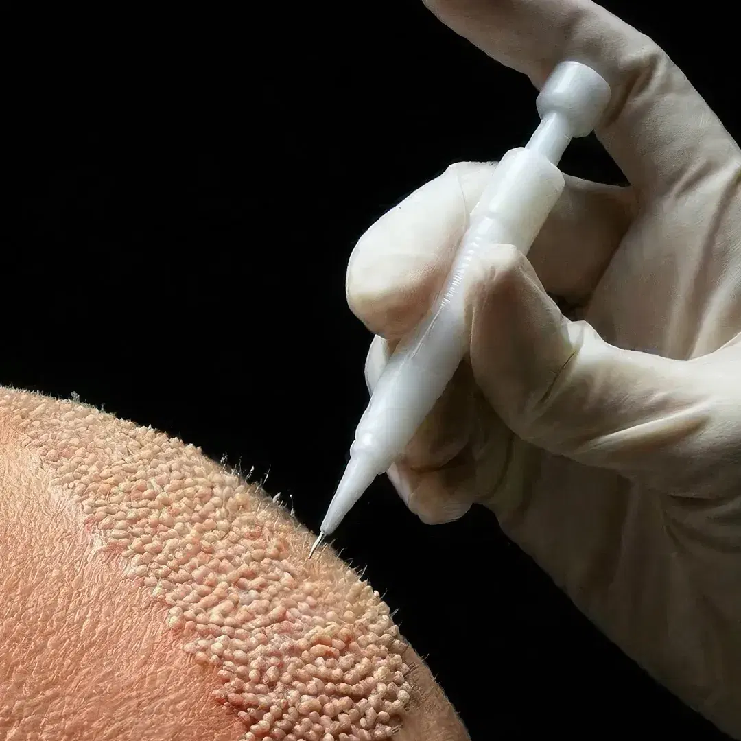 DHI Hair Transplant