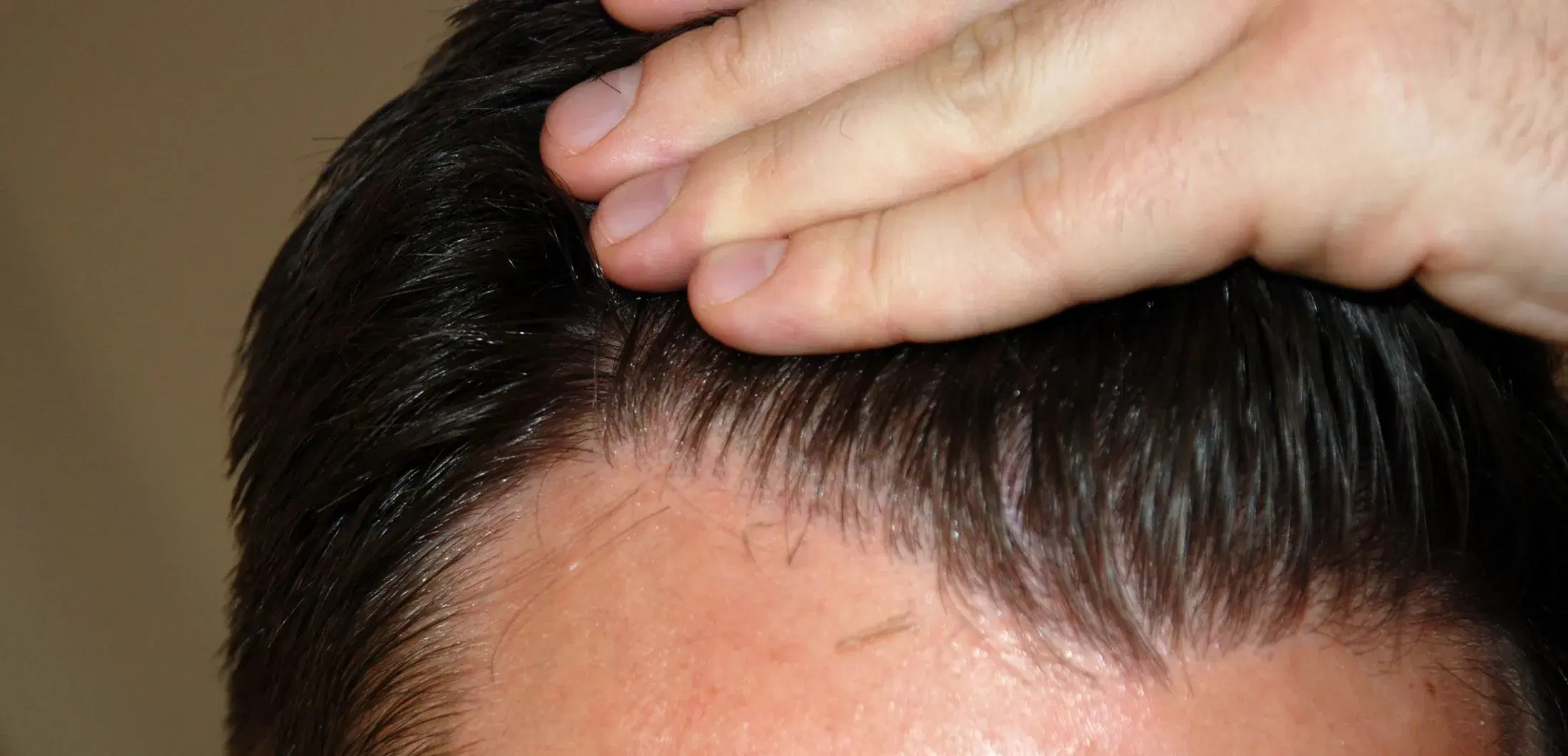 Hair Transplant Result