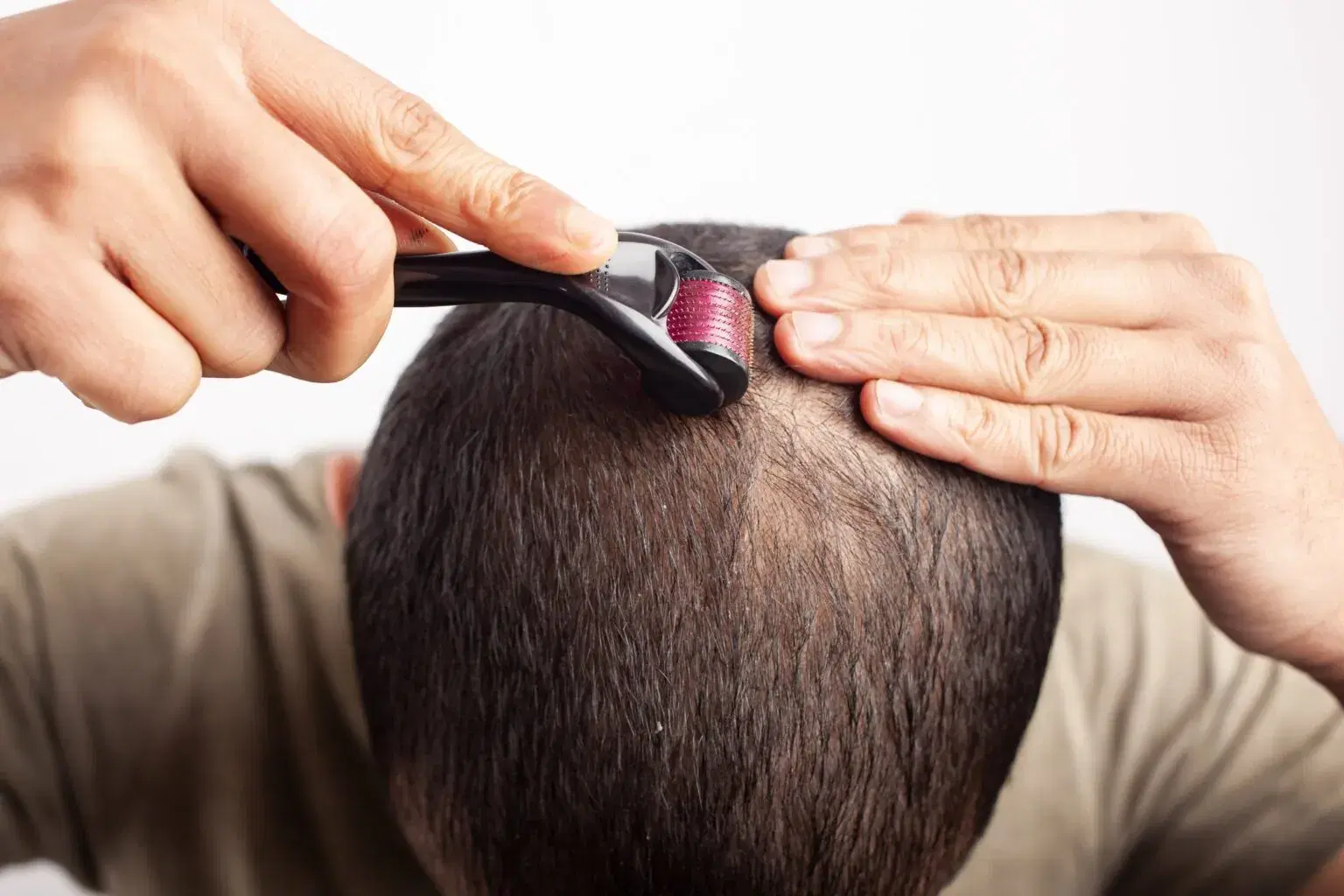 Microneedling for Hair Loss