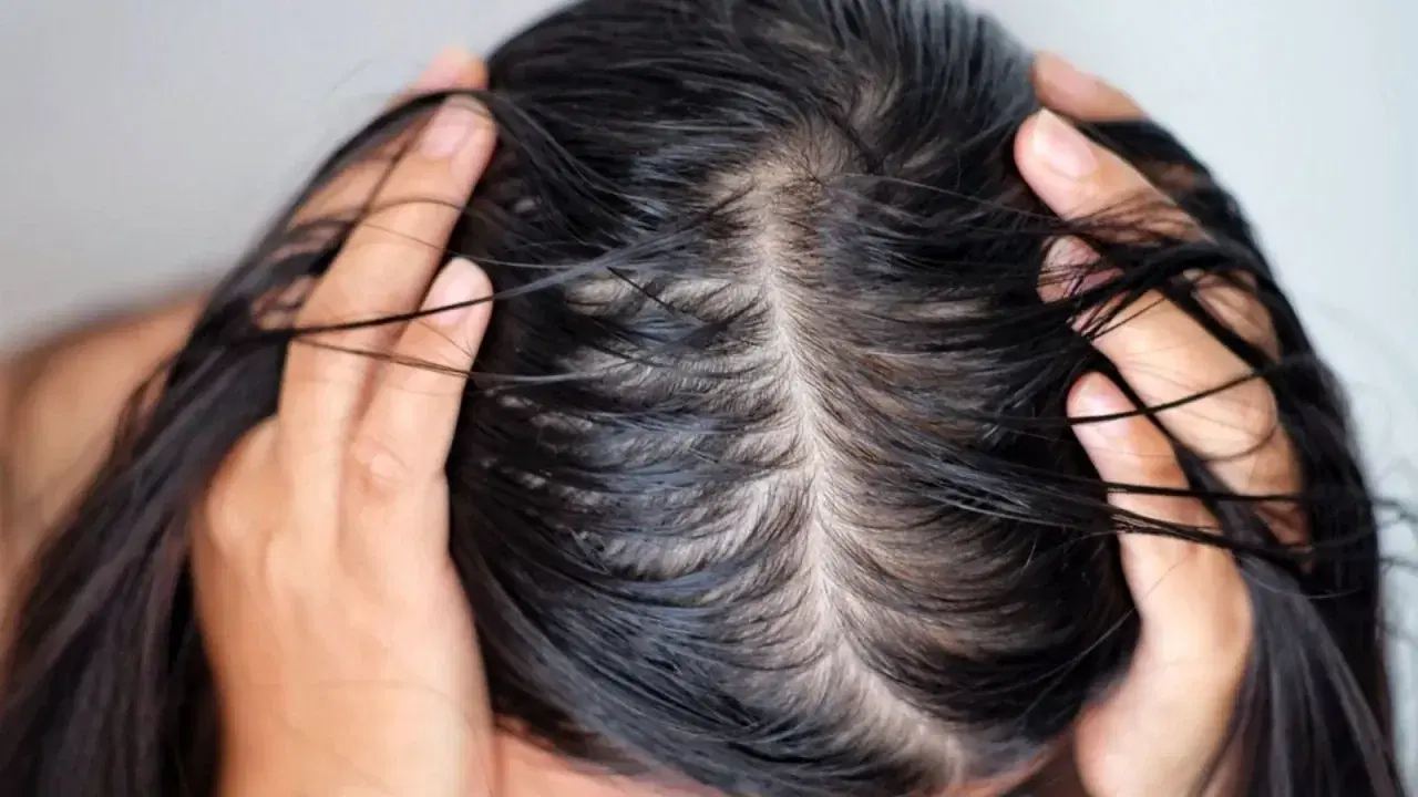 Oily Scalp