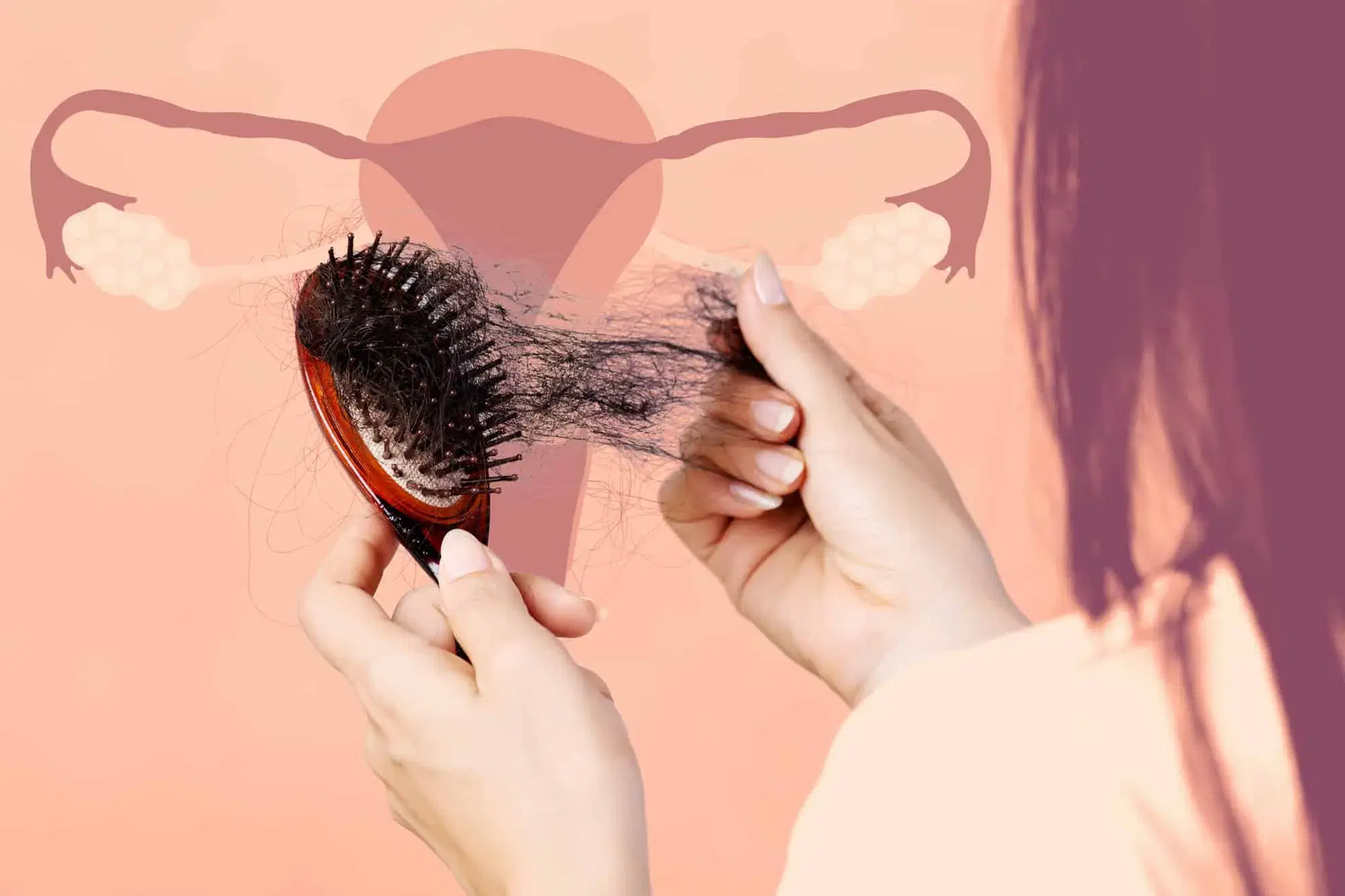 PCOS and Hair Loss