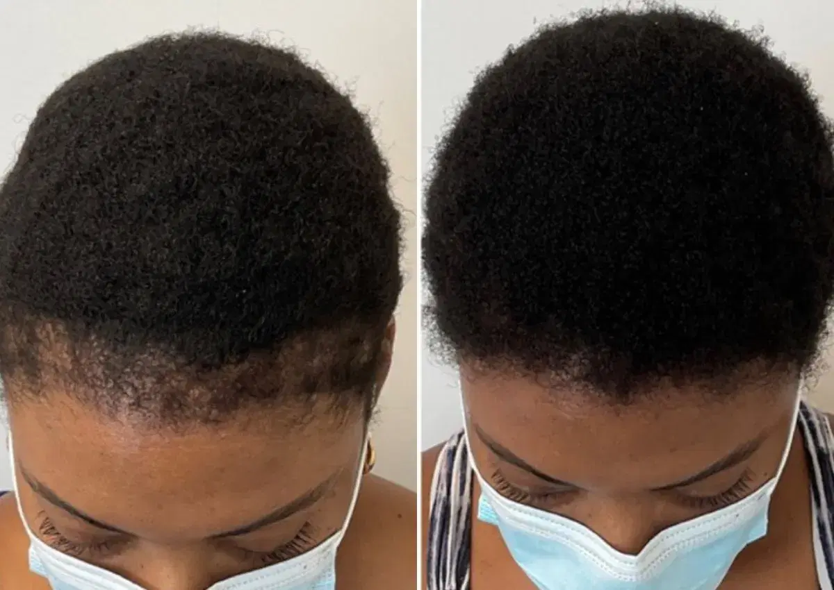 afro hair transplant