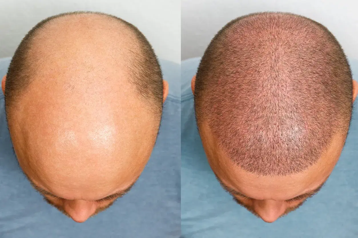 hair transplant