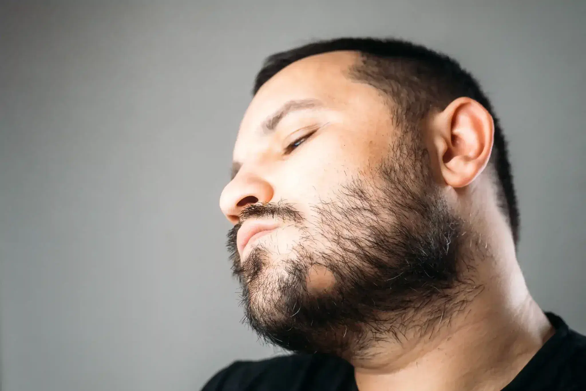 Bad Beard Transplant