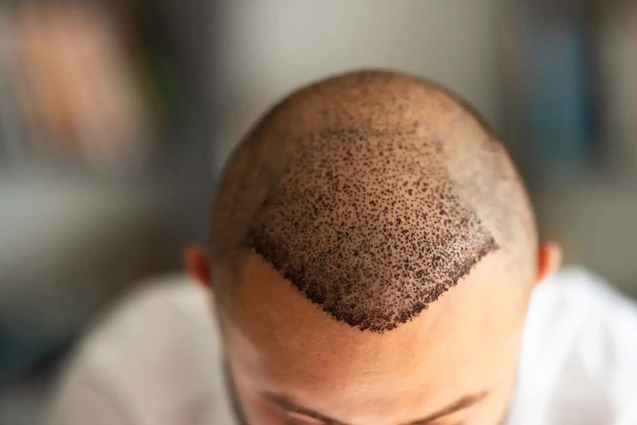 What Happens If You Hit Your Head After Hair Transplant?