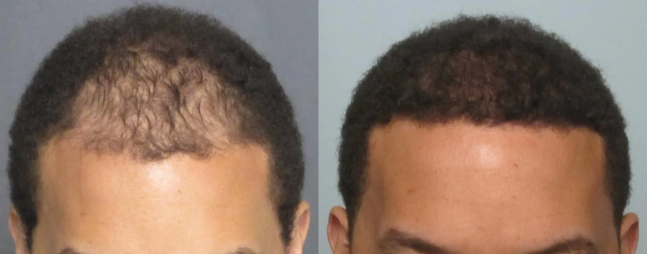 Hair Transplant for Men With Very Straight Hair