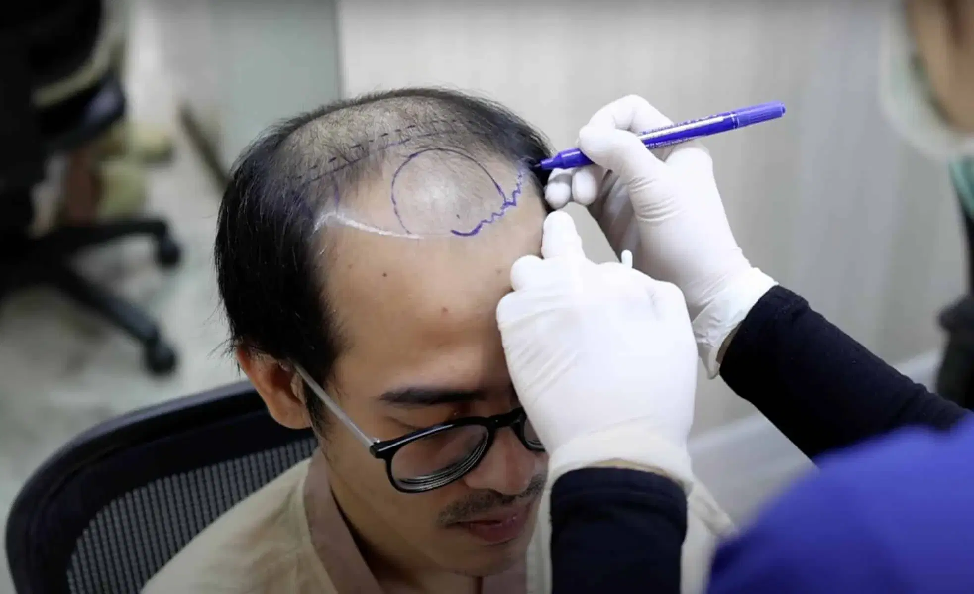 Hair Transplant for Thick Asian Hair