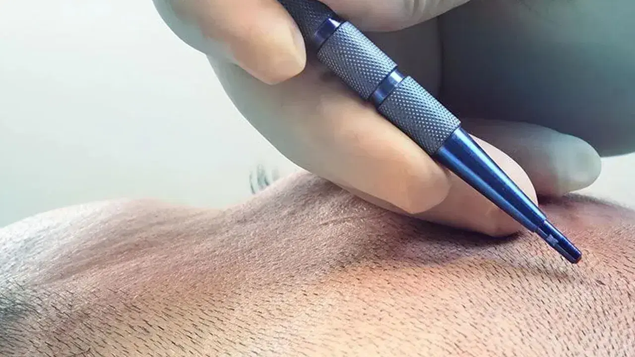 Hair Transplant with Sapphire FUE