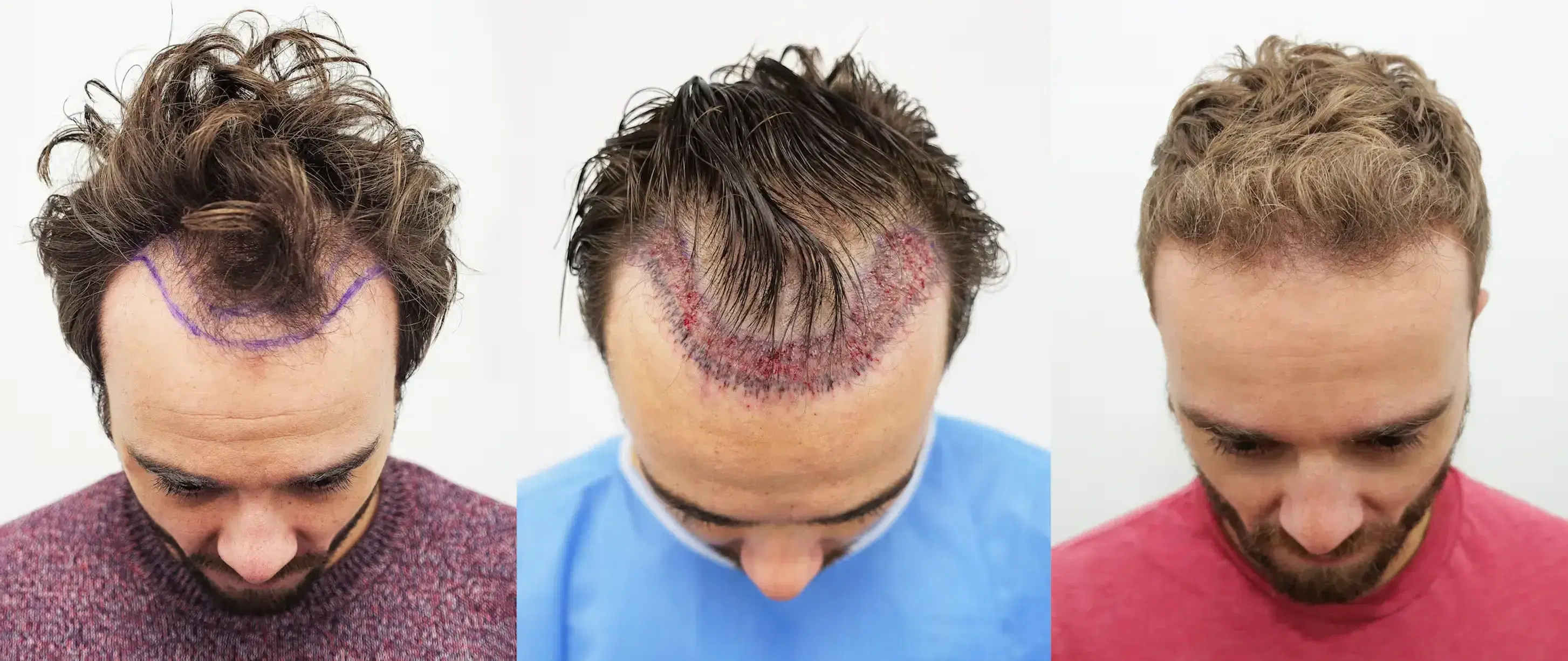 How Many Hair Transplants Can One Person Have