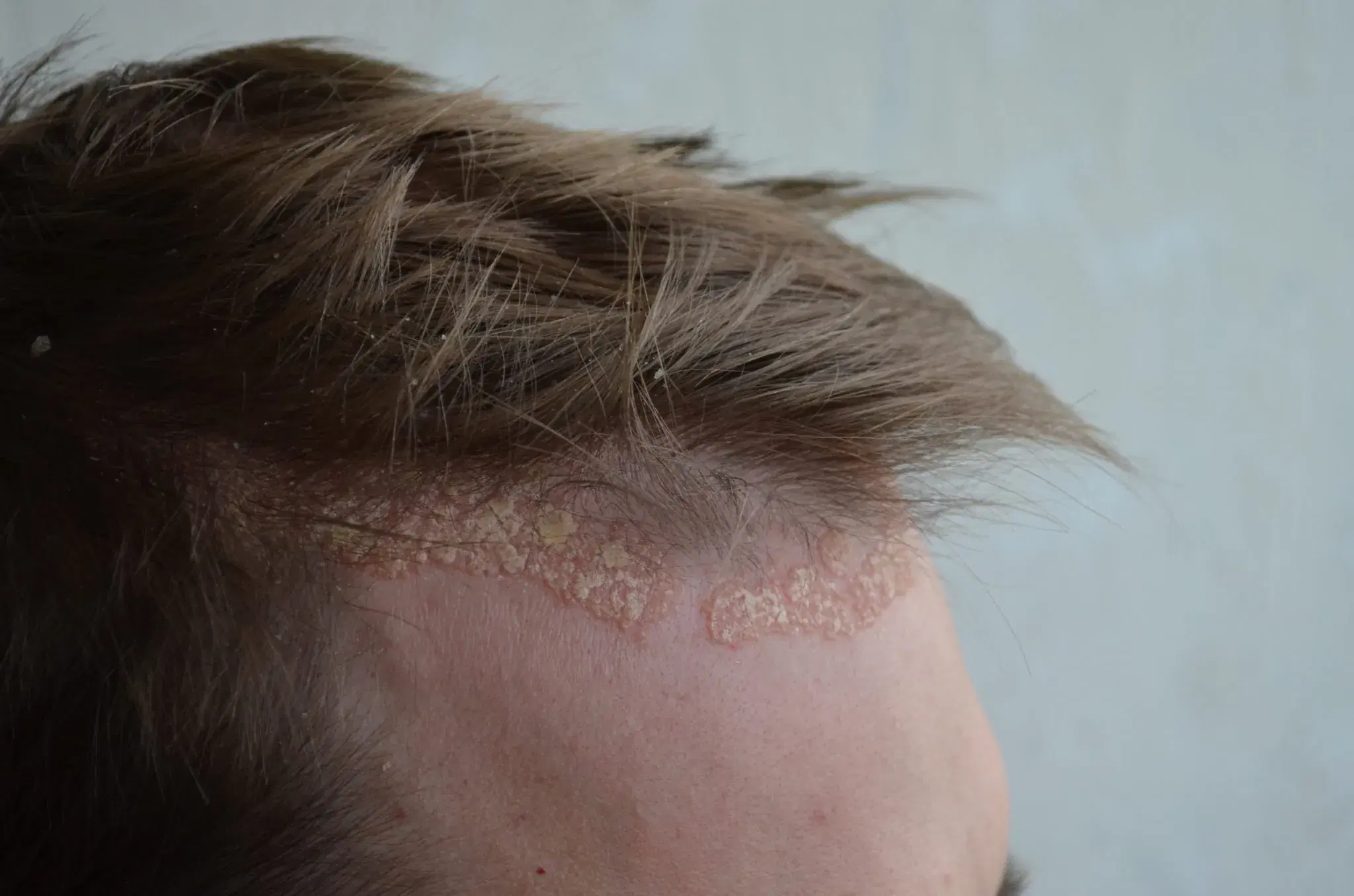 Scalp Inflammation