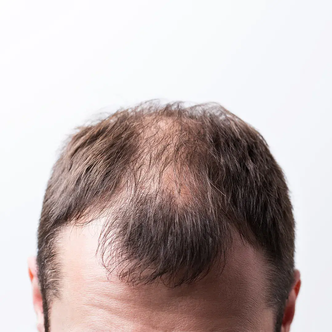 Pattern Baldness (Androgenetic Alopecia) in Men and Women